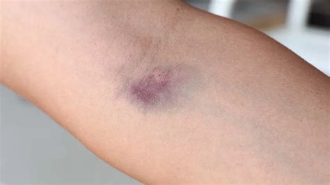 Vein Damage From IV Drug Use - ARK Behavioral Health