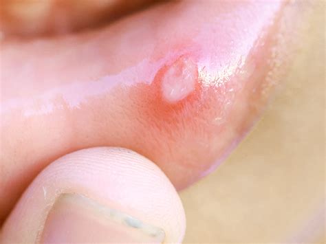 Canker sore on lip: Causes, risk factors, and treatment