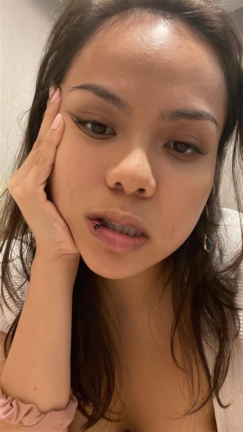 Post surgery after mucocele removal; how long before scar tissue goes
