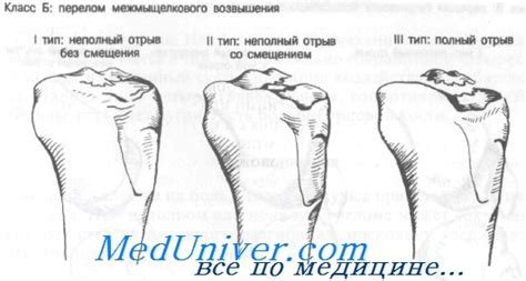Переломы межмыщелкового возвышения большеберцовой кости. Классификация ...