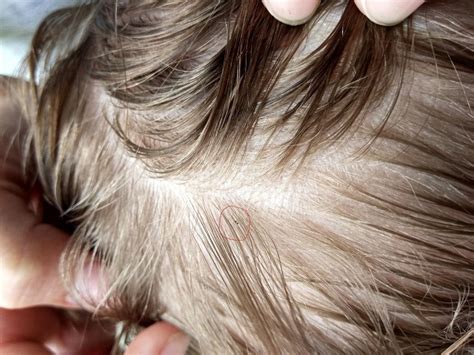 WHAT DO LICE LOOK LIKE UP CLOSE | LiceDoctors