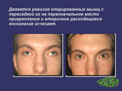 Косоглазие. Причины, виды - презентация онлайн