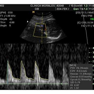 The placenta succenturiata after delivery. An inferior | Download ...