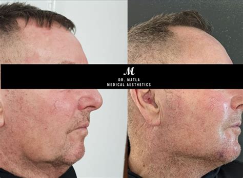 pdo threadlift  cramlington high quality mint pdo threads