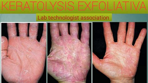 Everything you know about keratolysis exfoliativa - YouTube