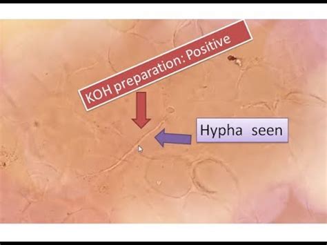 Positive Koh Test