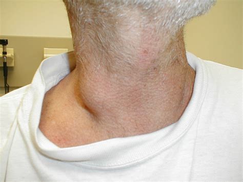 swollen glands   neck   infoupdateorg