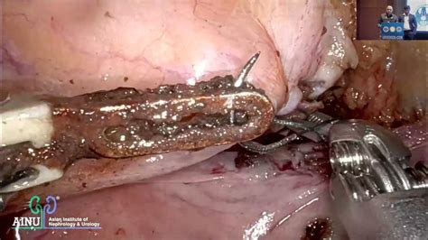 radical nephro ureterectomy special aspects  dr md ghouse dr rajesh