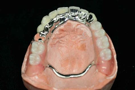 metal frame denture design - americancruisercampervan