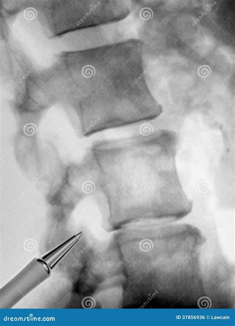 X-ray Of Lumbar Vertebrae Royalty-Free Stock Photo | CartoonDealer.com ...