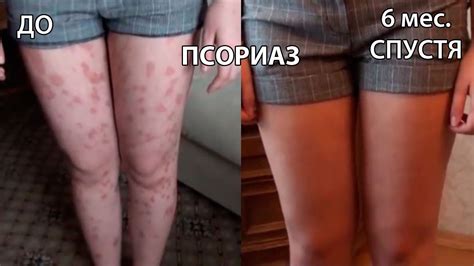 Излечение ПСОРИАЗА - YouTube