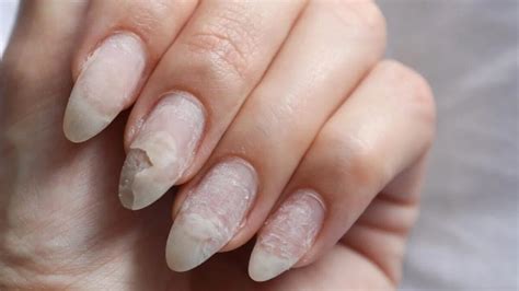 Unha Descamando Na Raiz - Unhas descamando: causas e tratamentos eficazes