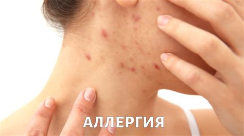 Почему возникает АЛЛЕРГИЯ и как с ней бороться? - YouTube