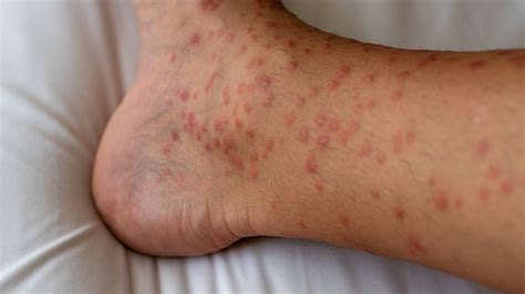 Understanding Hives and Its Treatments — NYC Allergy Doctor | Dr ...