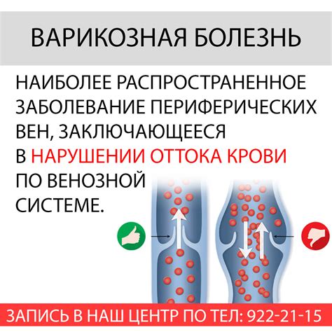 Чем опасна варикозная болезнь