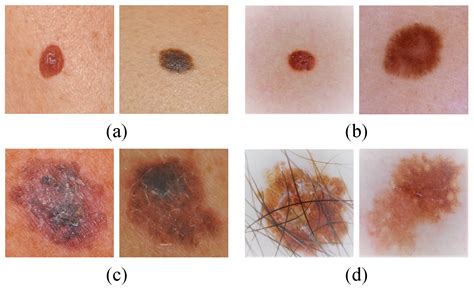 Benign Nevus Vs Melanoma