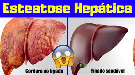 O Que É Esteatose Hepática - O que é Esteatose Hepática? Causas e Tipo? - Gordura no Figado - YouTube