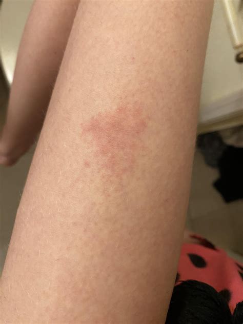 Rash help! : r/DermatologyQuestions