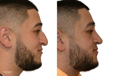 nose types male