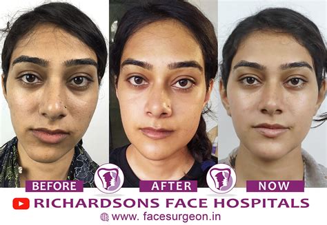 Facial Asymmetry Surgery – Richardson's Plastic Surgery Hospitals
