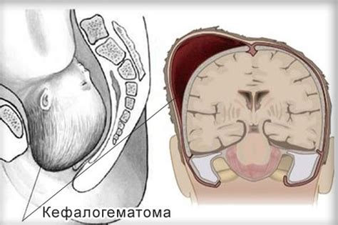 Лечение кефалогематомы в Израиле