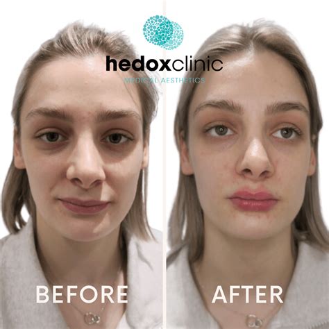Asymmetrical Face Correction