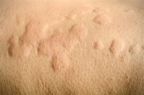 Rheumatoid Arthritis Skin Issues: Hives, Rashes, & More