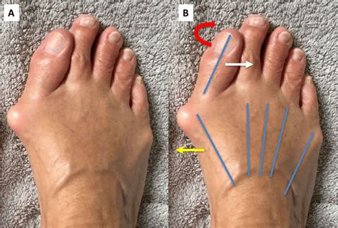 hallux valgus deformity  hallux valgus bunion treatment