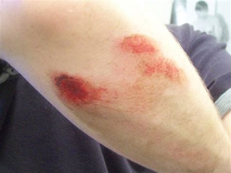 skin level injuries bleedingskin infections flashcards quizlet