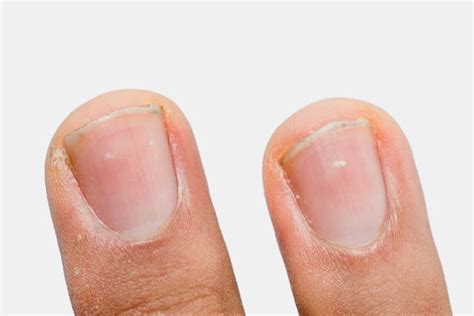 White Spots on Nails: What Causes Them & How to Treat - Tua Saúde