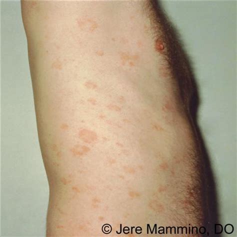 Pityriasis Rosea Rash On Back