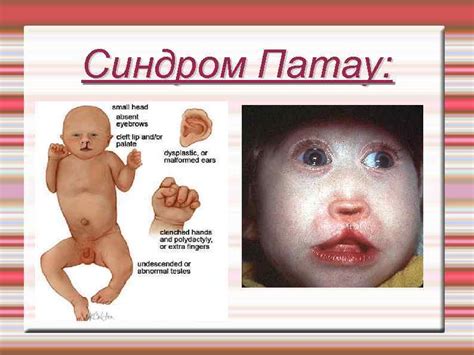 Синдром Патау История Синдром Патау синдром трисомии