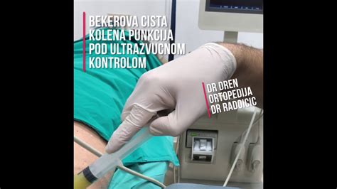 Bekerova cista Punkcija Beker ciste #bekerovacista # ...