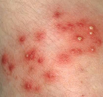 staph infection  contagious symptoms treatment  pictures