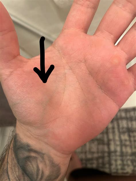 Vein in my palm feels swollen and is discolored, anyone know what this