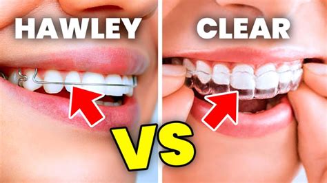 Deciding Between Hawley and Clear Retainers: Retainers 101