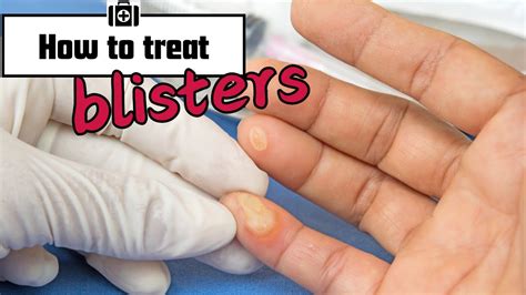 prevent  treat blisters simple tips  fast recovery youtube