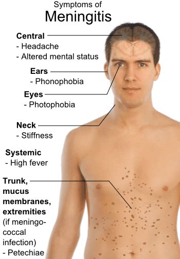 meningitis almostadoctor