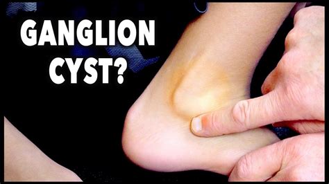 GANGLION CYST? | Dr. Paul - YouTube