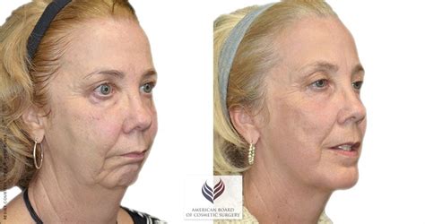 plastic surgery face lift  york magazine  plastic surgeons