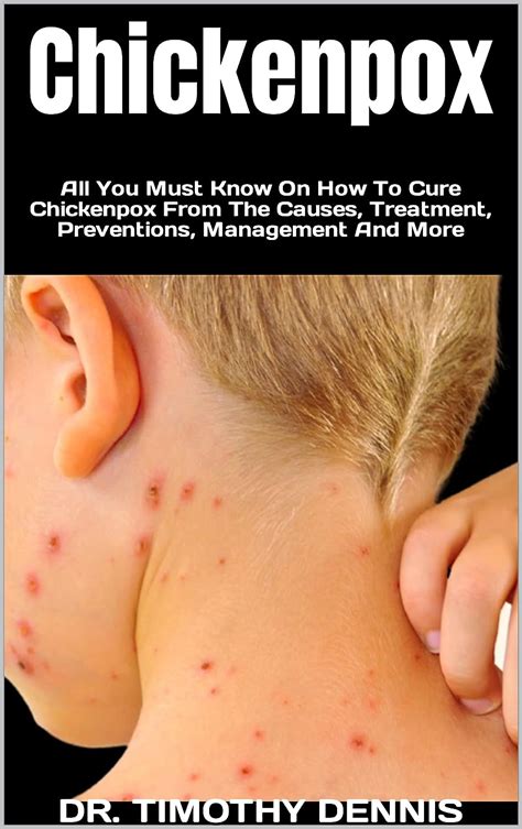 Chickenpox : All You Must Know On How To Cure Chickenpox From The ...