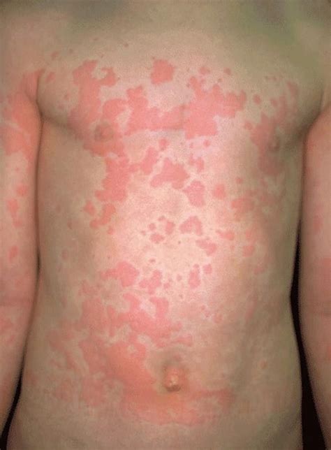 Overview of Allergic Reactions - Immune Disorders - Merck Manual ...