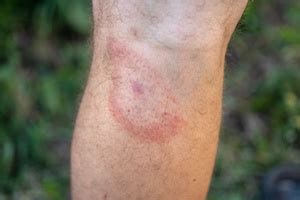 Kontrollera dina fästingbett för att undvika borrelia - cefam.se