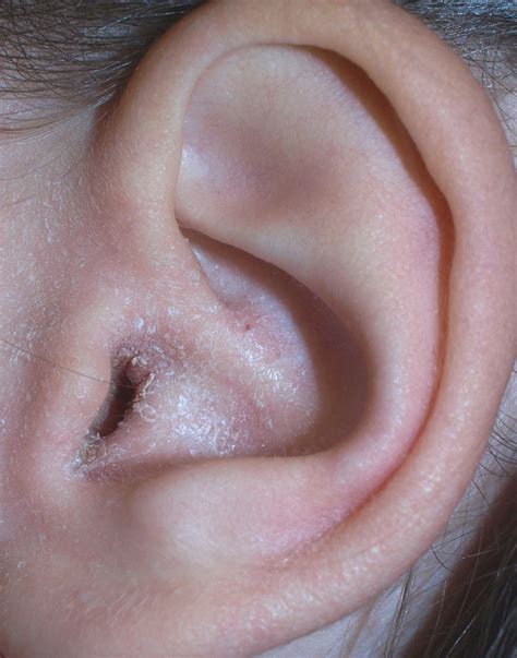 File:Eczema ear2.jpg - Wikipedia