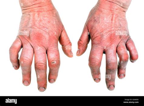 deformed hands  res stock photography  images alamy