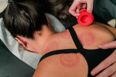 chiropractic cupping healthsource chiropractic