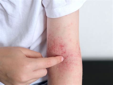O Que Pode Causar Dermatite - Dermatite: o que é, tipos, sintomas, causas e tratamentos