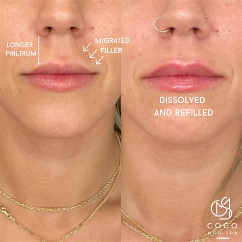 how long does it take for lip filler to dissolve