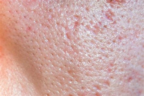 reducing large pores   tips  tricks lemon mask