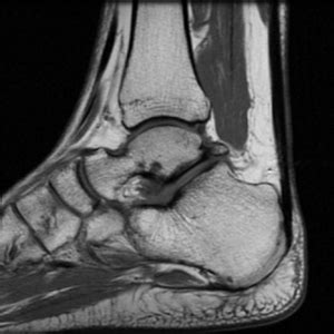 Basic-ankle-mri